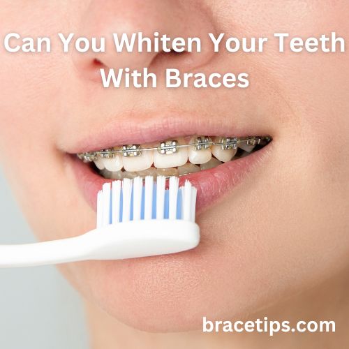 Can You Whiten Your Teeth With Braces