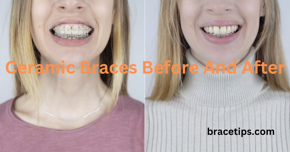 Ceramic Braces Before And After