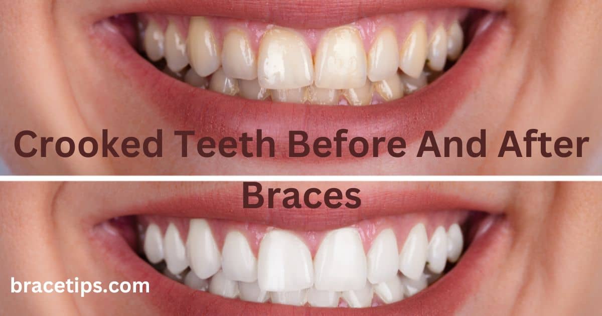 Crooked Teeth Before And After Braces