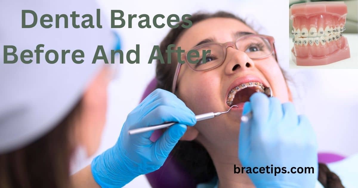 Dental Braces Before And After