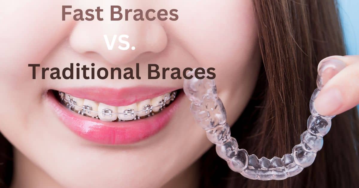 Fast Braces VS. Traditional Braces