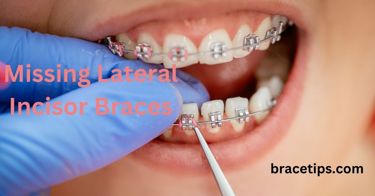 Missing Lateral Incisor Braces
