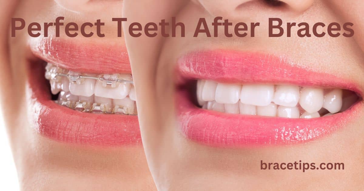 Perfect Teeth After Braces