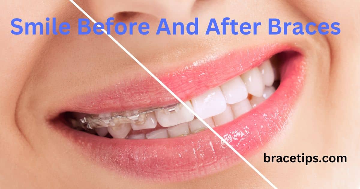 Smile Before And After Braces