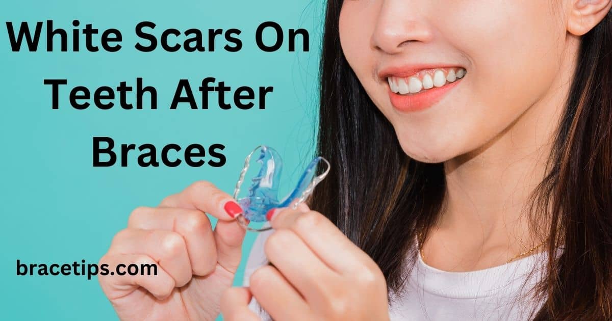 White Scars On Teeth After Braces