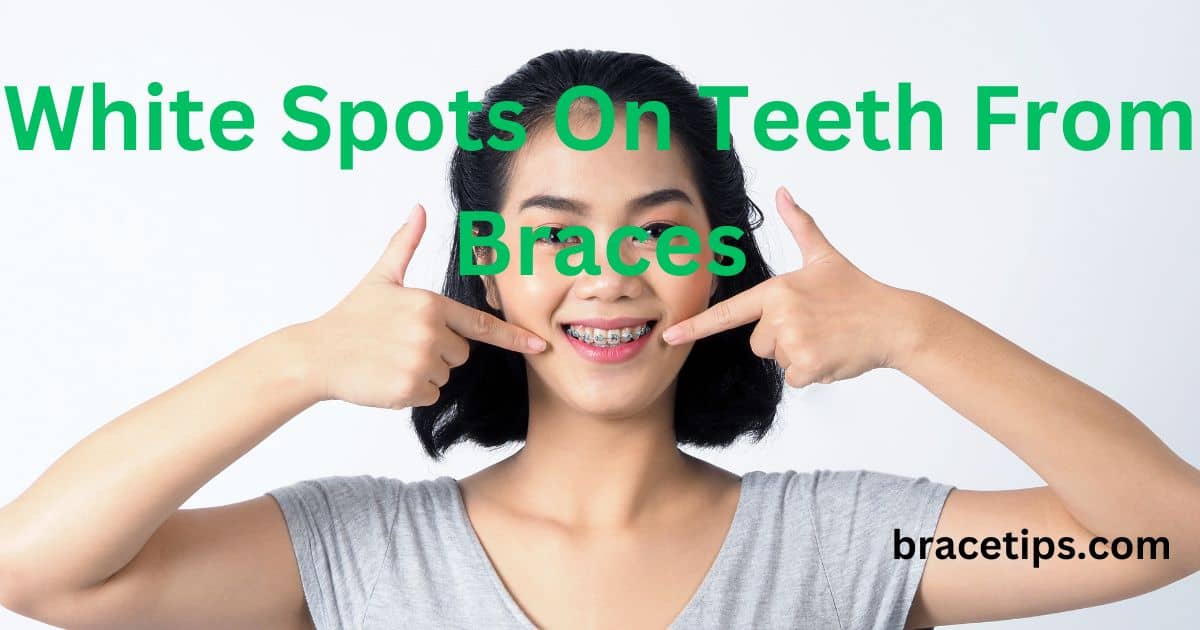 White Spots On Teeth From Braces